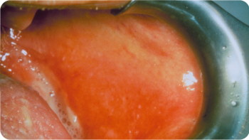 Photo of a close-up of a person's mouth displaying the impact of chemotherapy-related oral mucositis.