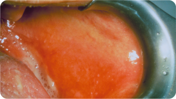 Photo of a close-up of a person's mouth displaying the impact of  chemotherapy-related oral mucositis.