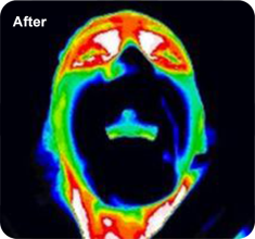 Intraoral scanning has shown that after using the device, the Chemo Mouthpiece cools the gums, tongue and palate (entire oral cavity) uniformly by reducing the patient's oral temperature.