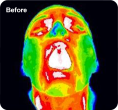 Thermographic imagery showing the patient before using the Chemo Mouthpiece.