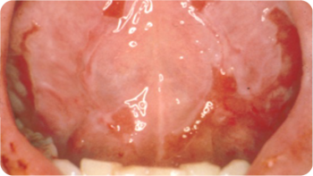 Picture of a close-up of a mucous membrane lining inside of the mouth showing the impact of oral mucositis.